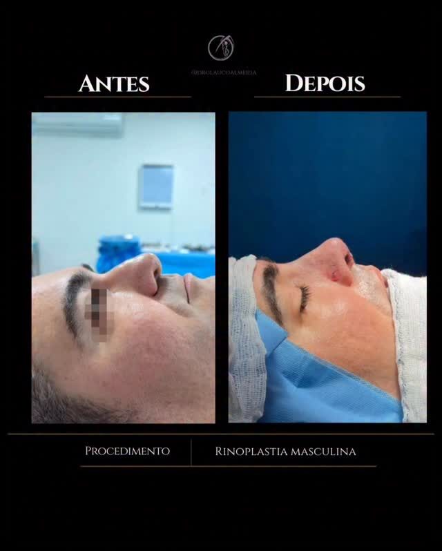 Instagram post from drglaucoalmeida. This post is in position 1.