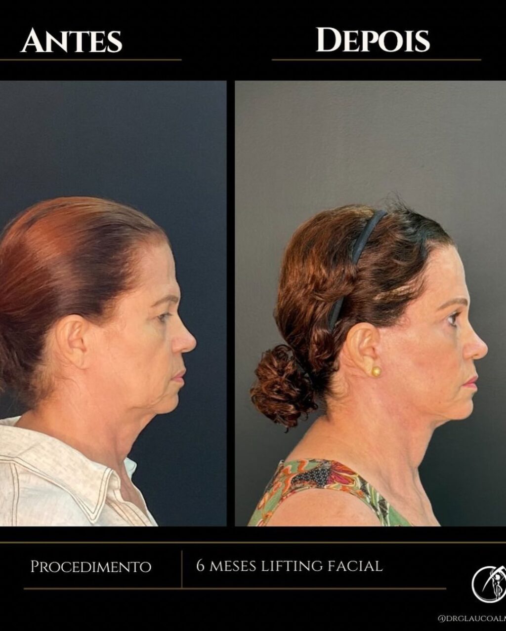 Instagram post from drglaucoalmeida. This post is in position 4.