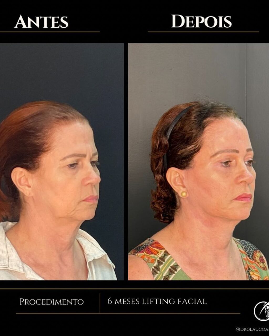 Instagram post from drglaucoalmeida. This post is in position 3.