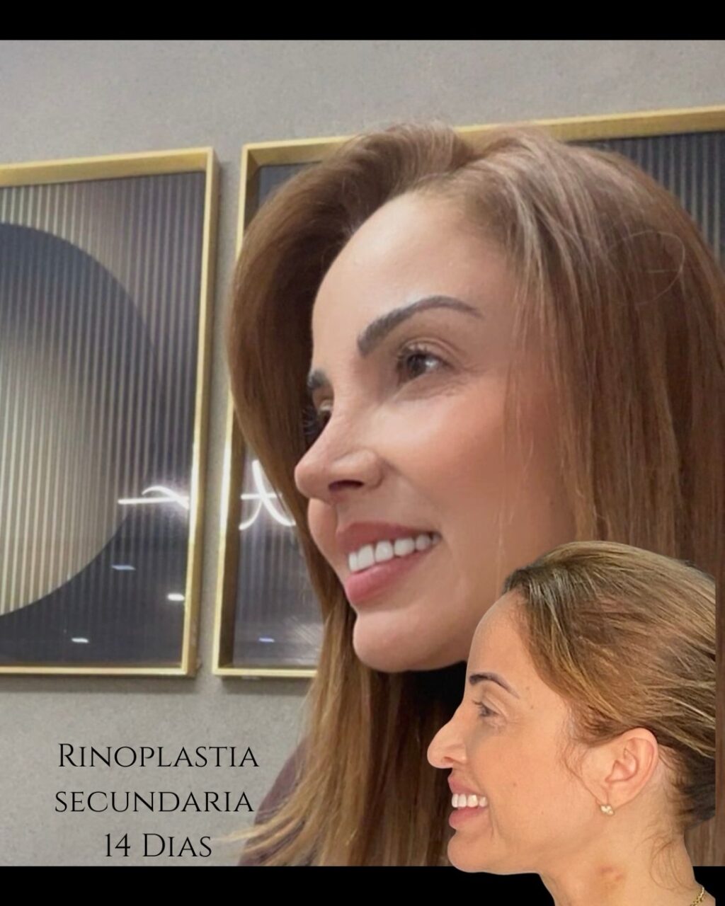 Instagram post from drglaucoalmeida. This post is in position 0.