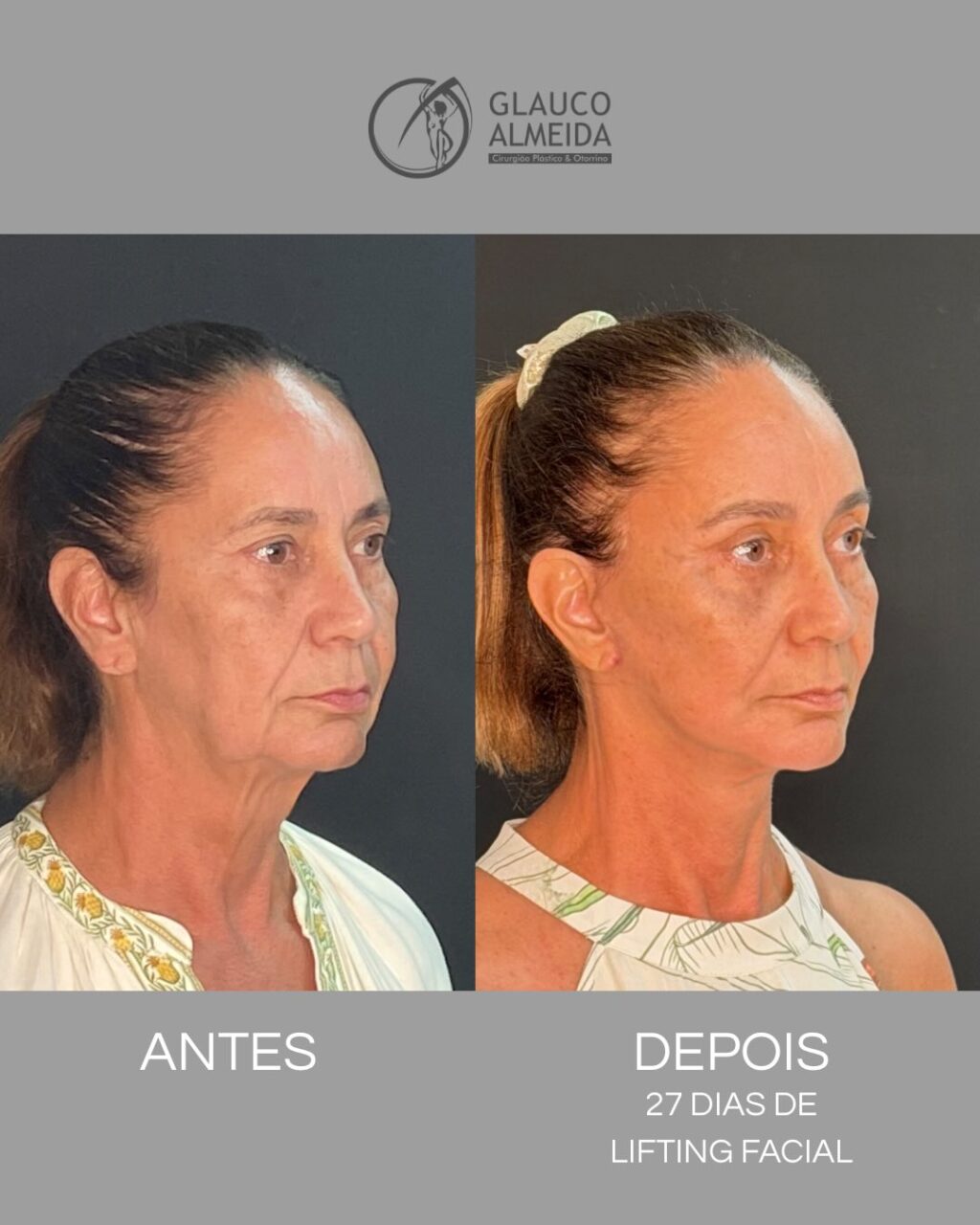 Instagram post from drglaucoalmeida. This post is in position 1.