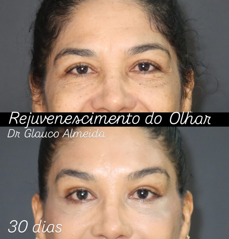Instagram post from drglaucoalmeida. This post is in position 1.