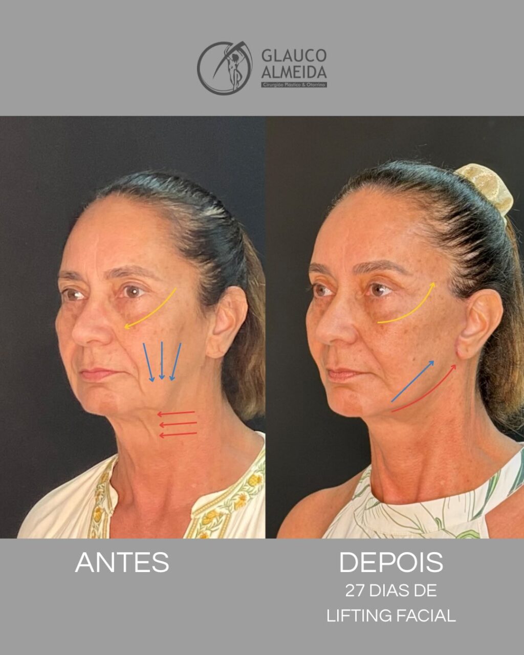 Instagram post from drglaucoalmeida. This post is in position 0.