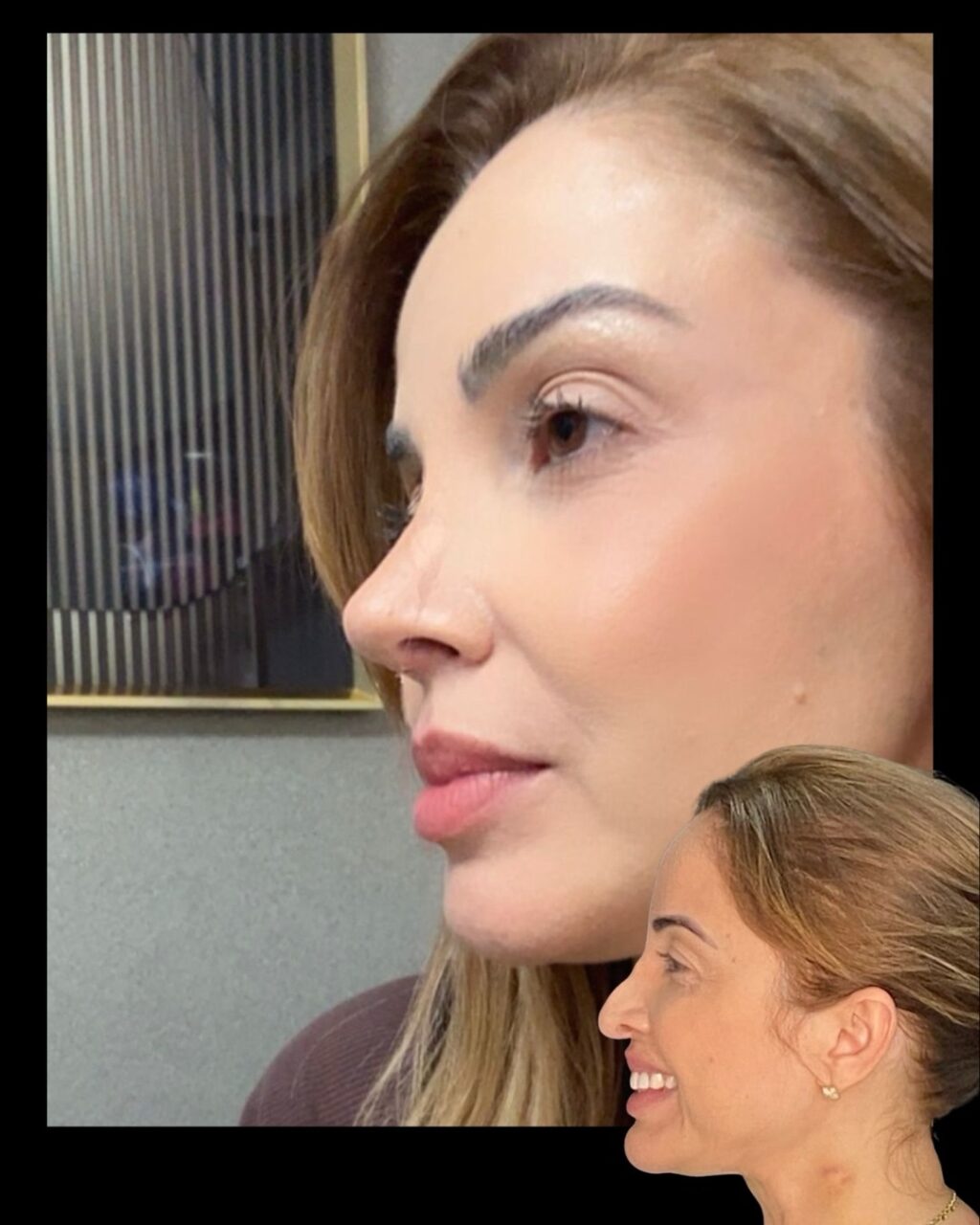 Instagram post from drglaucoalmeida. This post is in position 2.