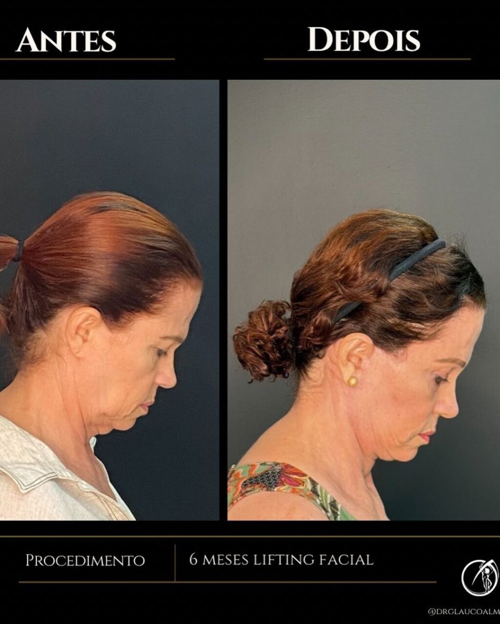 Instagram post from drglaucoalmeida. This post is in position 2.