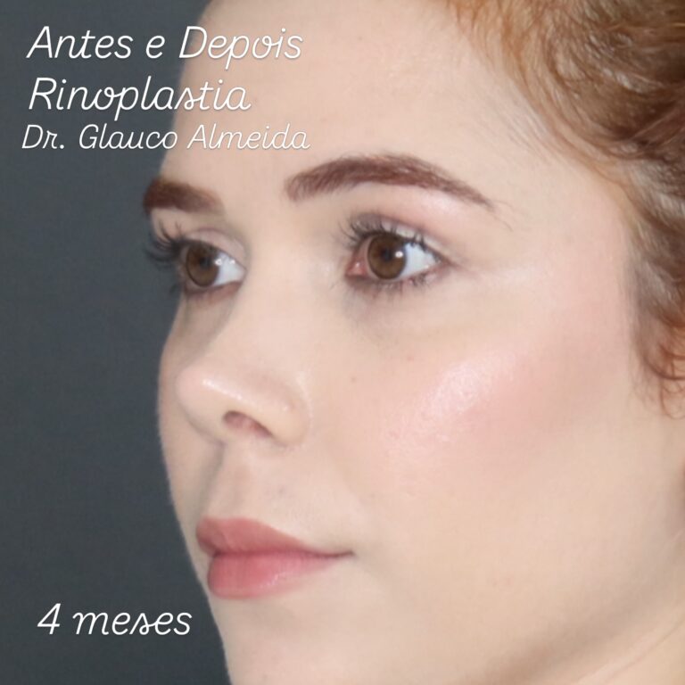 Instagram post from drglaucoalmeida. This post is in position 1.