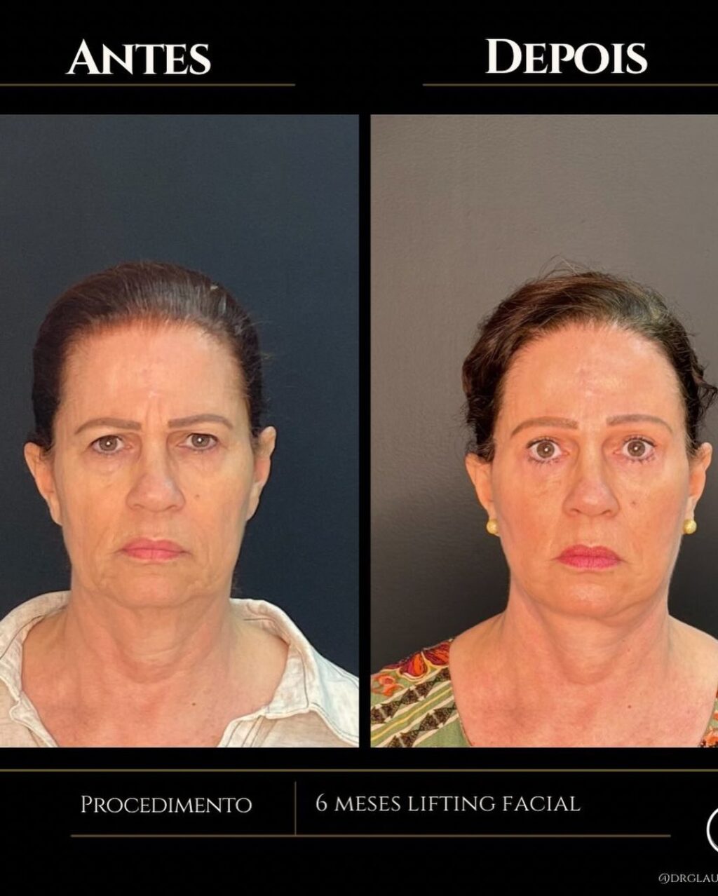 Instagram post from drglaucoalmeida. This post is in position 1.