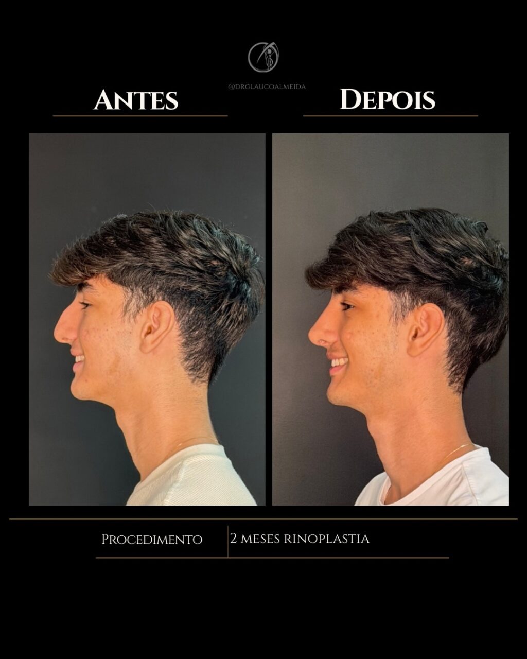 Instagram post from drglaucoalmeida. This post is in position 1.