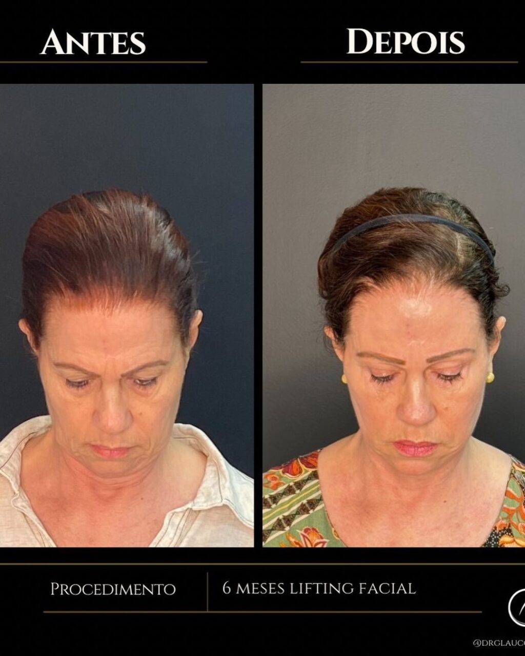 Instagram post from drglaucoalmeida. This post is in position 5.